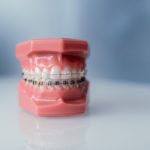 Comment être remboursé des frais d'orthodontie pour adulte ?